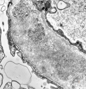 F,16y. | type III membranoproliferative glomerulonephritis F,16y. | type III membranoproliferative glomerulonephritis